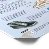 糖尿病足気にポスタ – Netter Chart ポスター (角)