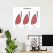 結核タイプポスター ポスター (ホームオフィス)