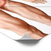 結腸の憩室イラストレーション ポスター (角)