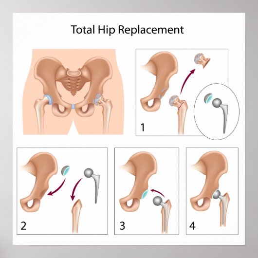総お尻置換手術プリント ポスター (正面)