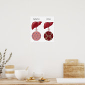 肝疾患肝硬変ポスター ポスター (キッチン)