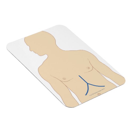 肝移植 マグネット (右側)