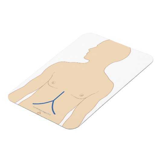 肝移植 マグネット (左側)