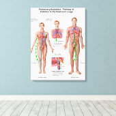 肺塞栓症、塞栓経路 キャンバスプリント (インサイチュ (ウッドフロア))