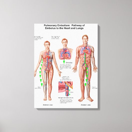 肺塞栓症、塞栓経路 キャンバスプリント (正面)