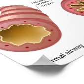 肺疾患喘息ポスター ポスター (角)