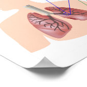 肺疾患(COPD)ポスター ポスター (角)
