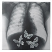 胃の蝶のX線 タイル (正面)