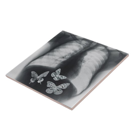 胃の蝶のX線 タイル (側面)