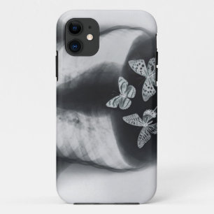 胃の蝶のX線 iPhone 11 ケース
