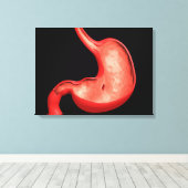 胃消化性潰瘍の概念像 キャンバスプリント (インサイチュ (ウッドフロア))