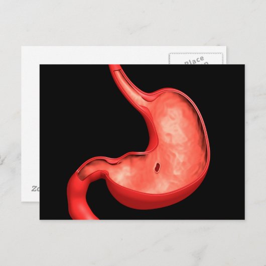 胃消化性潰瘍の概念像 ポストカード (正面/裏面)