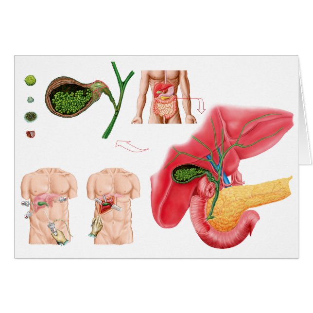 胆嚢摘出術イラストレーション (正面横)