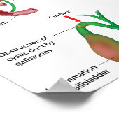 胆嚢摘出術ポスター ポスター (角)