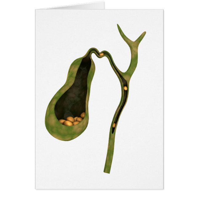 胆石内部の概念図 (正面)