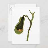 胆石内部の概念図 ポストカード (正面/裏面)