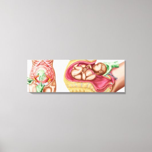 胎児の帝王切開分娩を示すイラストレーション キャンバスプリント (正面)