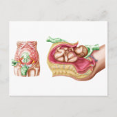 胎児の帝王切開分娩を示すイラストレーション ポストカード (正面)