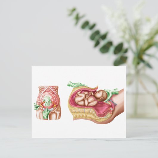 胎児の帝王切開分娩を示すイラストレーション ポストカード (スタンド正面)