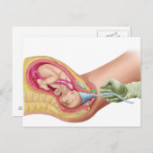 胎児1の分娩を示すイラストレーション ポストカード (正面/裏面)