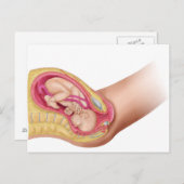 胎児2の分娩を示すイラストレーション ポストカード (正面/裏面)