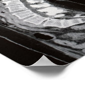 脊柱のMRI ポスター (角)