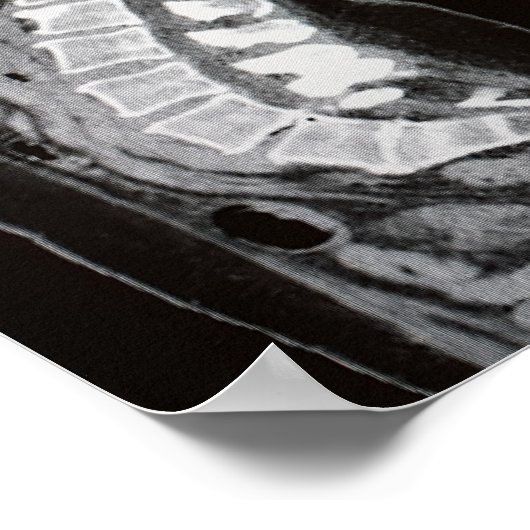 脊柱のMRI ポスター (角)
