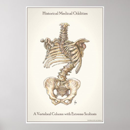 脊柱側弯症 ポスター (正面)