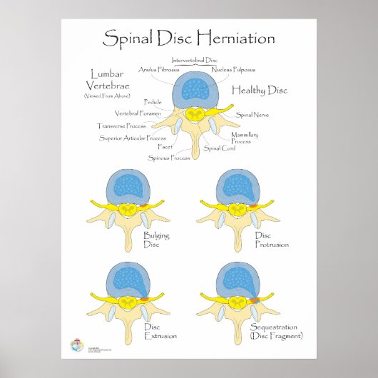 脊髄椎間板ヘルニア用ポスター医療ポスター ポスター (正面)