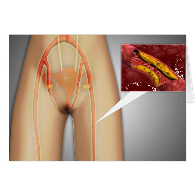脚の近くで狭窄した動脈 (正面横)