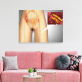 脚の近くで狭窄した動脈 キャンバスプリント (インサイチュ (リビング))