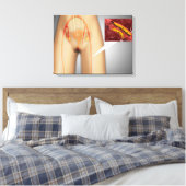 脚の近くで狭窄した動脈 キャンバスプリント (インサイチュ (寝室))