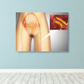 脚の近くで狭窄した動脈 キャンバスプリント (インサイチュ (ウッドフロア))