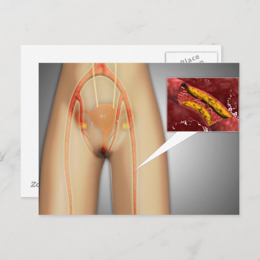 脚の近くで狭窄した動脈 ポストカード (正面/裏面)