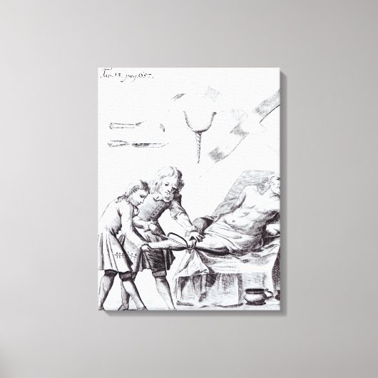 脚を切断する外科手術 キャンバスプリント (正面)