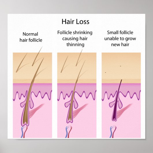 脱毛プロセスポスター ポスター (正面)
