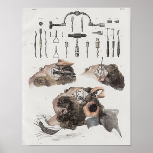 脳外科楽器ヴィンテージ解剖学プリント ポスター (正面)