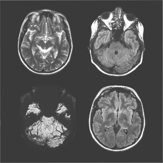 脳MRIスキャン シール (正面)