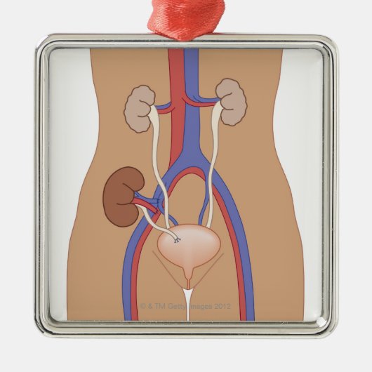腎臓の移植 メタルオーナメント (正面)