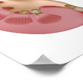 腎臓結石ポスター ポスター (角)