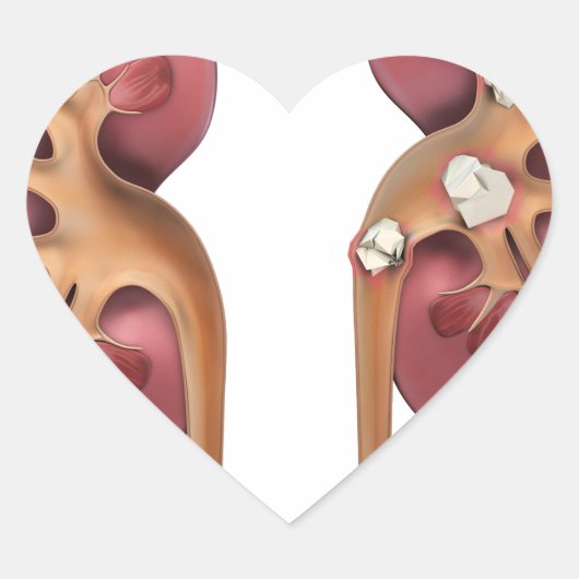 腎臓 ハートシール (正面)