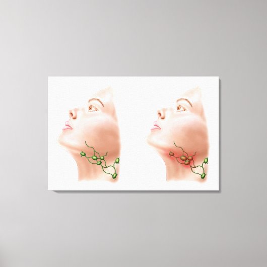 腫れたリンパ節の解剖学 キャンバスプリント (正面)