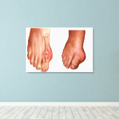 腫れた足 キャンバスプリント (インサイチュ (ウッドフロア))