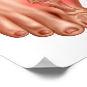 腫れた足 ポスター (角)