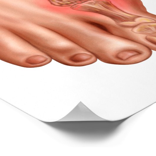 腫れた足 ポスター (角)