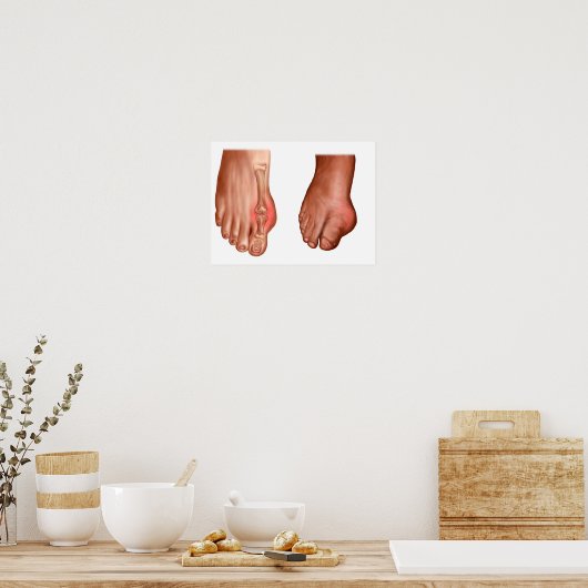 腫れた足 ポスター (キッチン)