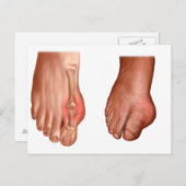 腫れた足 ポストカード (正面/裏面)