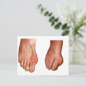 腫れた足 ポストカード (スタンド正面)