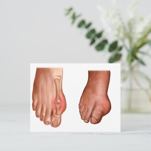 腫れた足 ポストカード (スタンド正面)