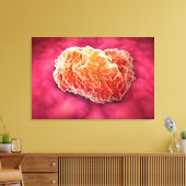 腫瘍の顕微鏡的見解3 キャンバスプリント (インサイチュ (リビング))